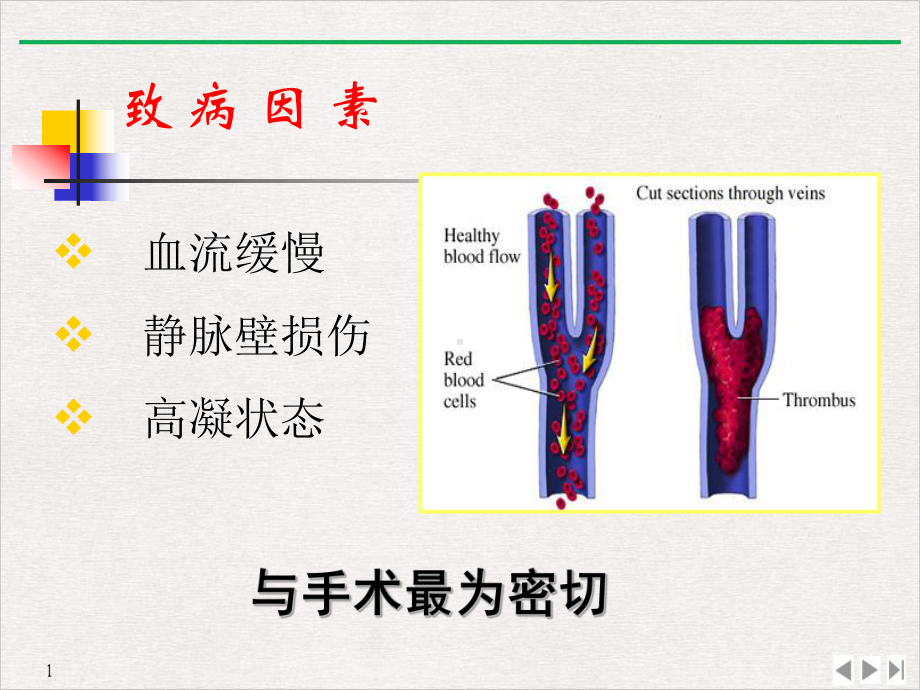 骨科大手术DVT预防公开课课件.pptx_第2页