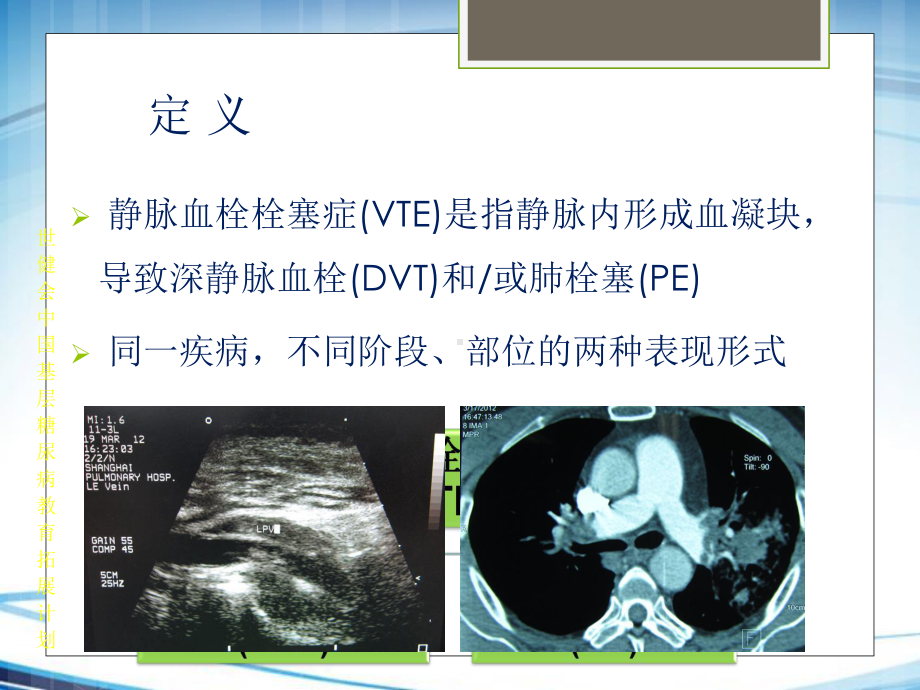 肿瘤相关性静脉血栓栓塞症的诊断与治疗课件.ppt_第2页