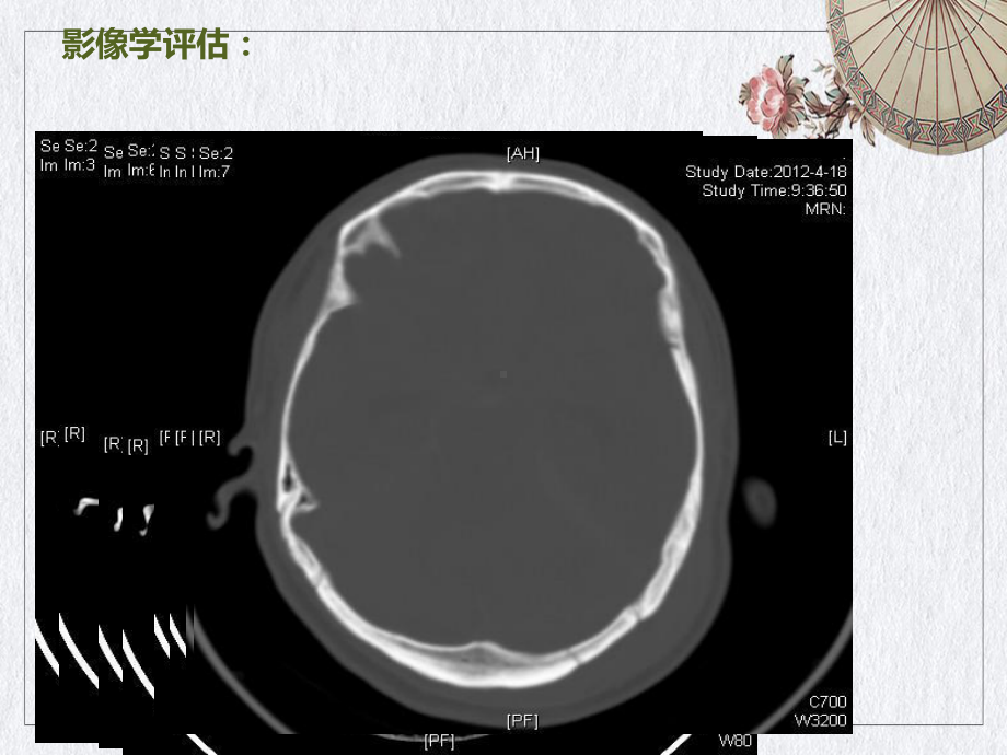 颅内压监测在重型颅脑损伤治疗中的应用课件.pptx_第1页