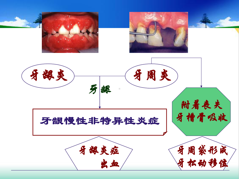 牙周病学牙周病的主要症状和临床病理课件.pptx_第1页