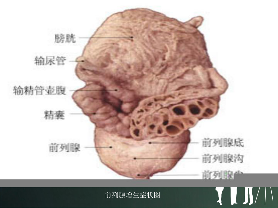 经尿道前列腺电切术后的护理课件精美版.pptx_第2页