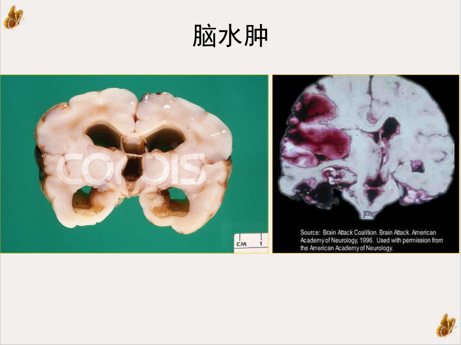 神经系统损伤与自由基关系及抗自由基治疗课件.ppt_第3页