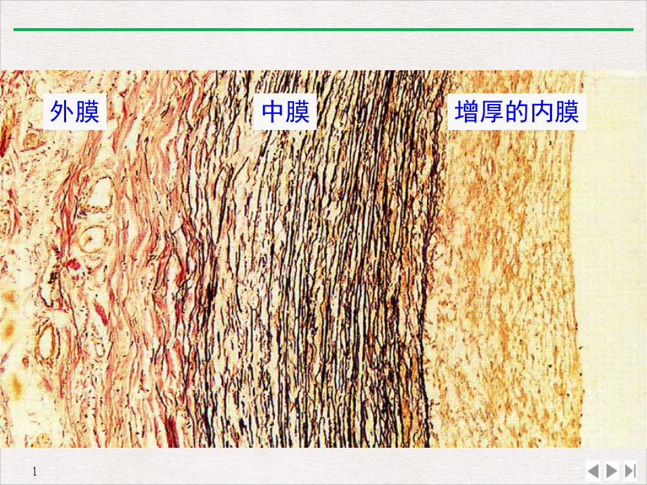 高血压对靶器官的损害课件.ppt_第2页