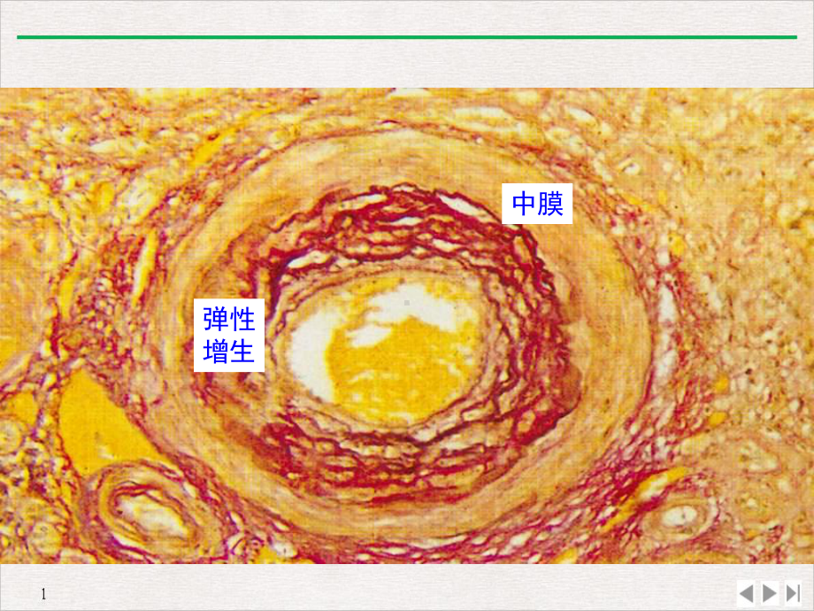 高血压对靶器官的损害课件.ppt_第3页