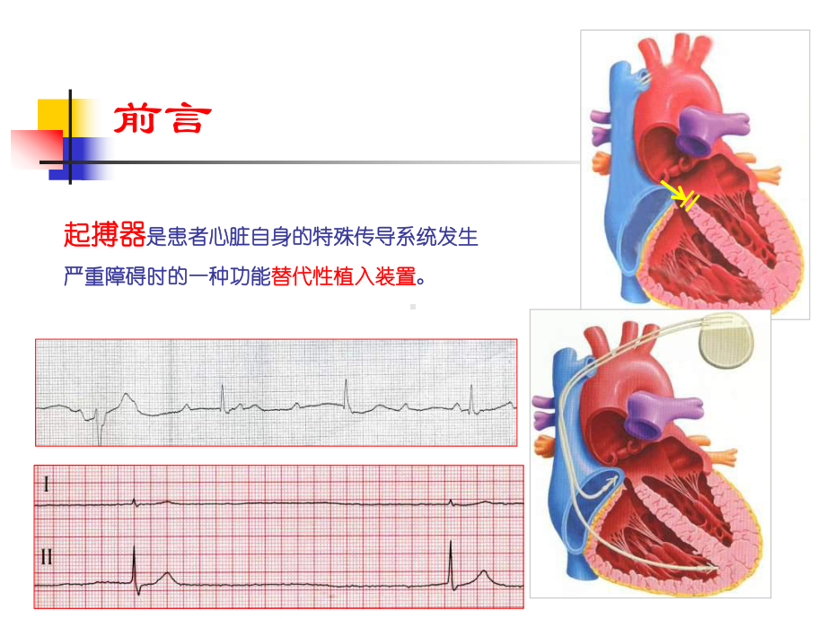 起搏器计时间期的意义课件.ppt_第2页