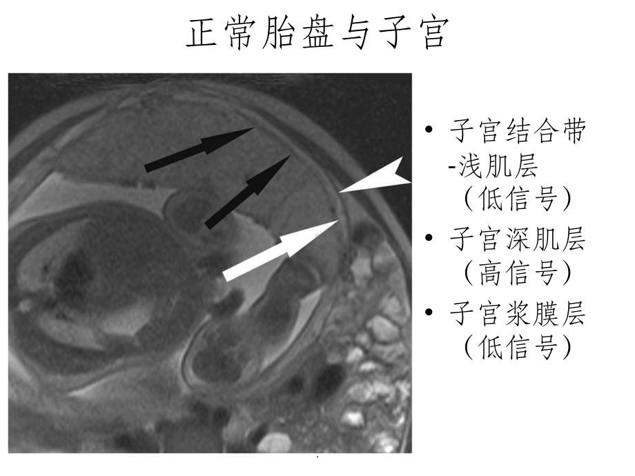 胎盘植入的磁共振表现课件.ppt_第3页