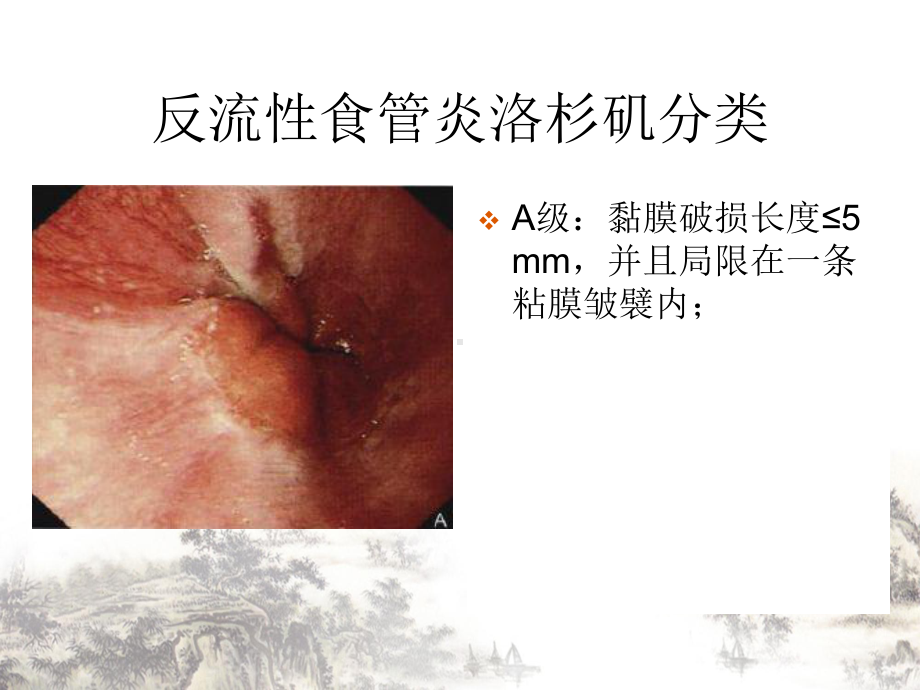 消化道疾患内镜分级诊断培训课件整理.ppt_第2页