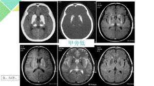 甲状旁腺功能减退症课件整理.pptx