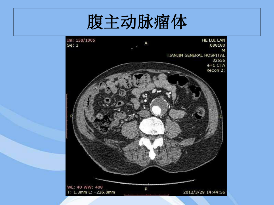 输入道闭塞扭曲腹主动脉瘤合并髂动脉多发动脉瘤一例课件.ppt_第2页