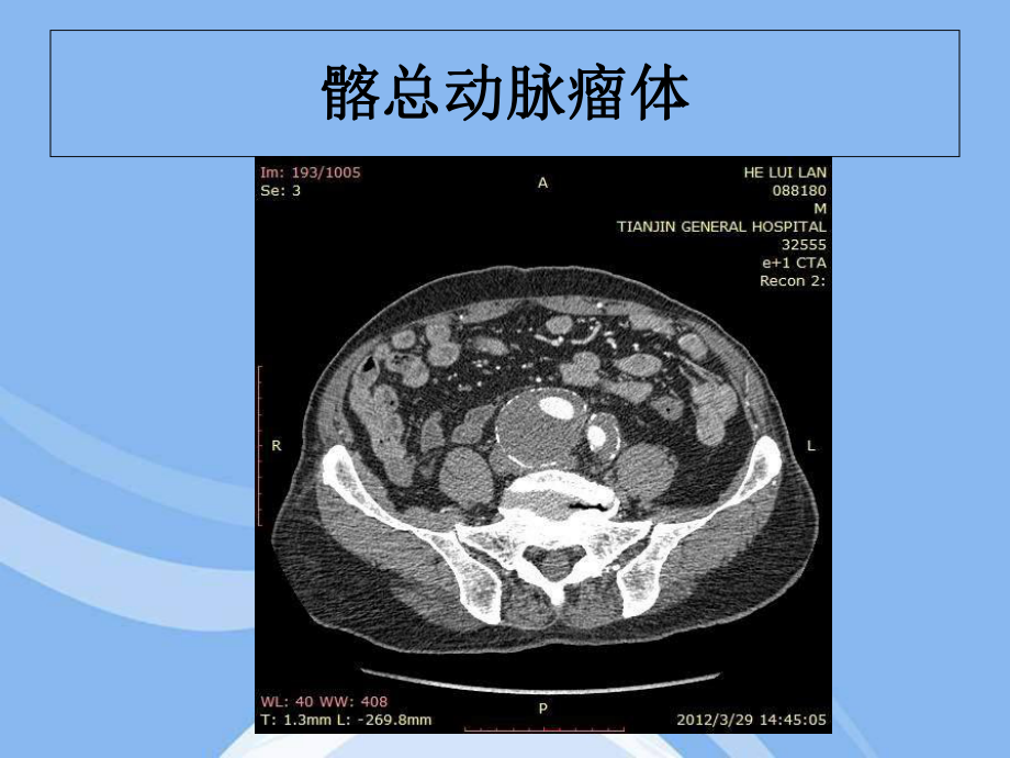 输入道闭塞扭曲腹主动脉瘤合并髂动脉多发动脉瘤一例课件.ppt_第3页