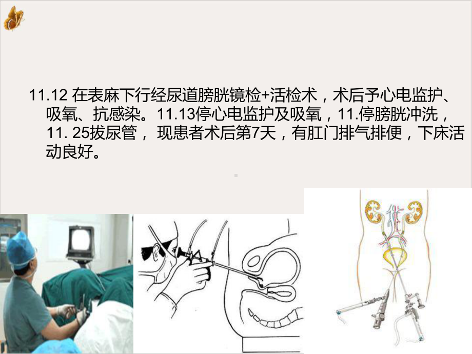 输尿管癌的护理查房详解课件.pptx_第2页