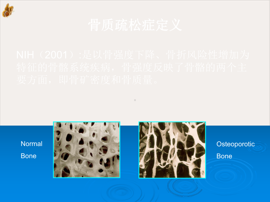 骨质疏松症的危险因素筛查及早期诊断培训课件.pptx_第3页