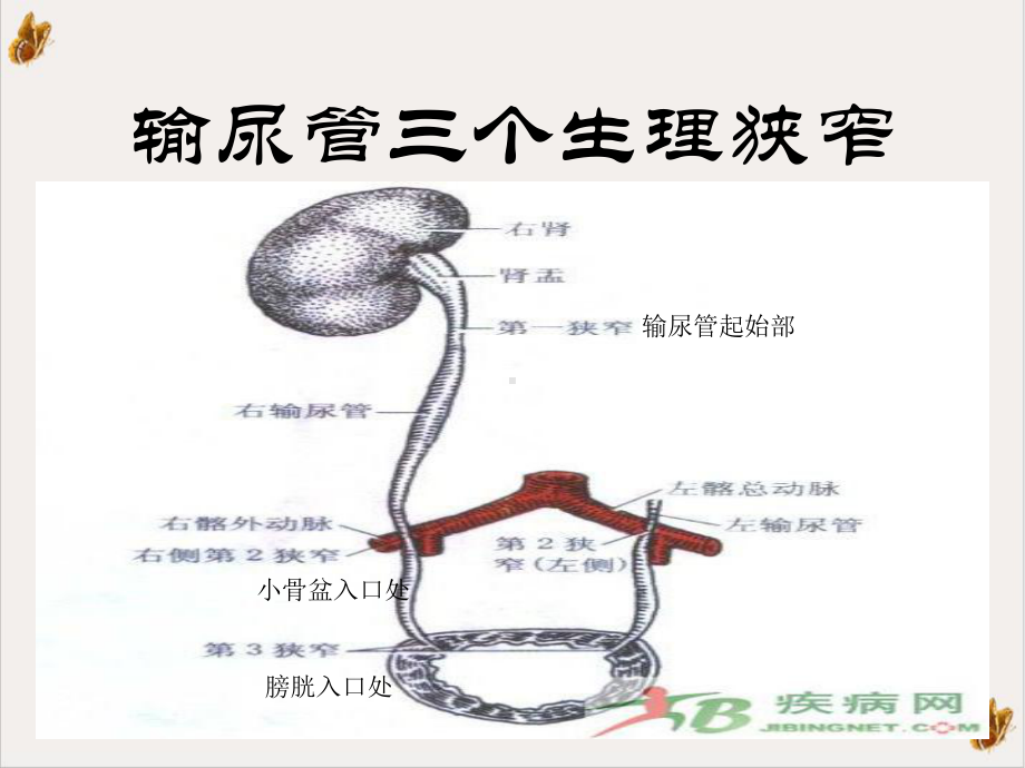 输尿管结石病人的护理课件.ppt_第2页