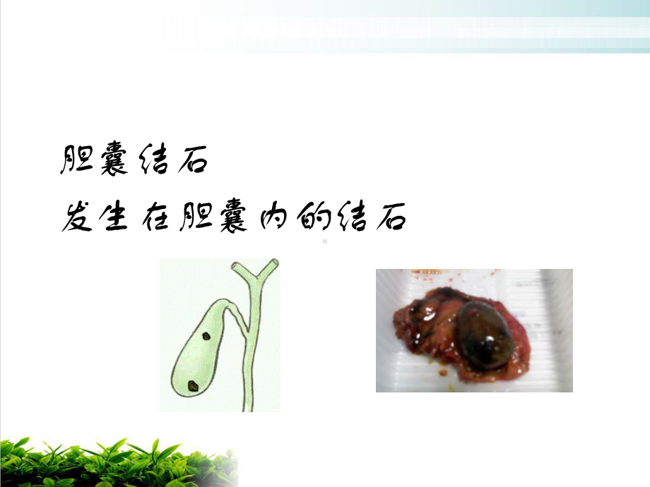 胆囊结石新优质课件.ppt_第3页