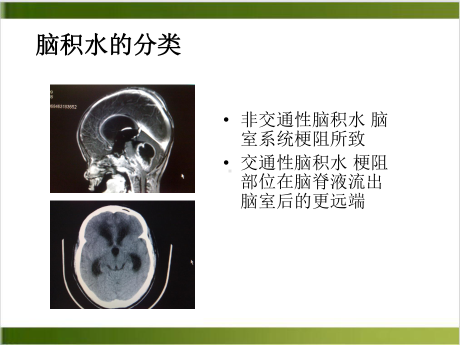 颅脑和脊髓先天性畸形课件.pptx_第3页