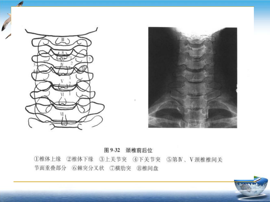 颈椎X线诊断判断椎体退变课件.pptx_第3页