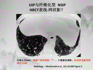 特发性肺纤维化HRCT诊断及鉴别诊断共四部分附大量图谱课件.pptx