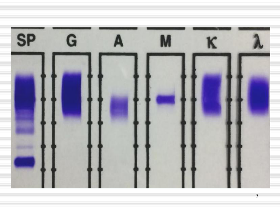 电泳结果解析在临床应用的价值课件.ppt_第3页