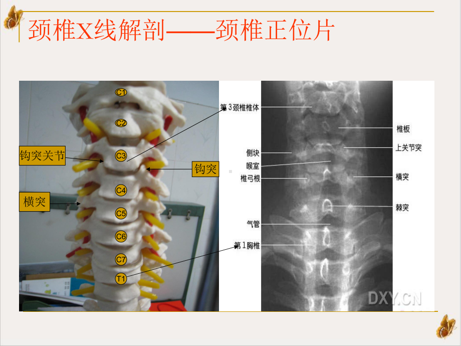 颈椎X线诊断判断椎体退变培训课程课件.pptx_第2页