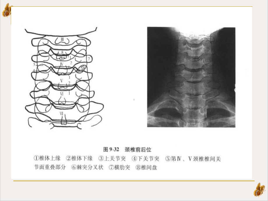 颈椎X线诊断判断椎体退变培训课程课件.pptx_第3页