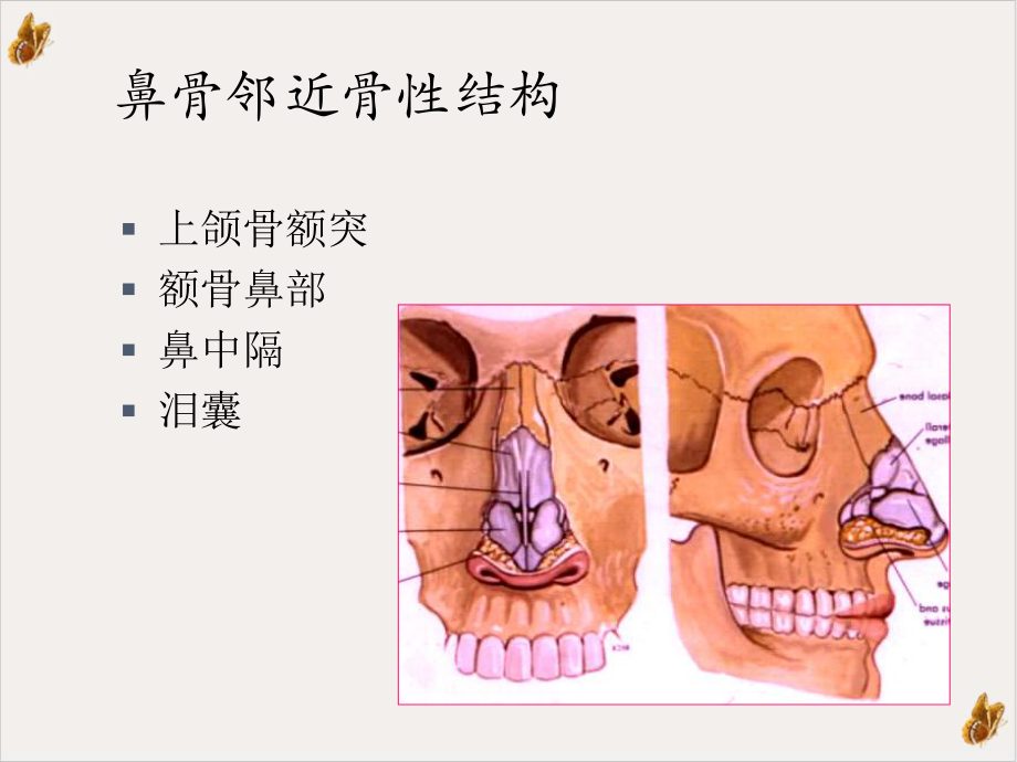 鼻骨骨折影像学诊断与鉴别课件.ppt_第2页