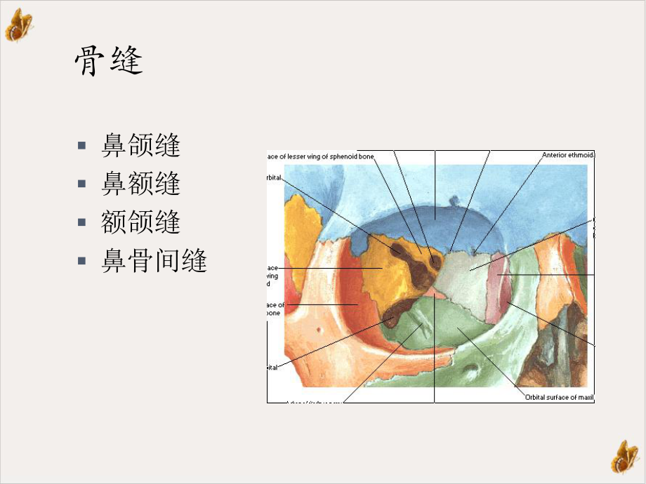 鼻骨骨折影像学诊断与鉴别课件.ppt_第3页