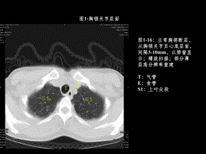 胸部ct解剖及典型病例CT征象课件.ppt