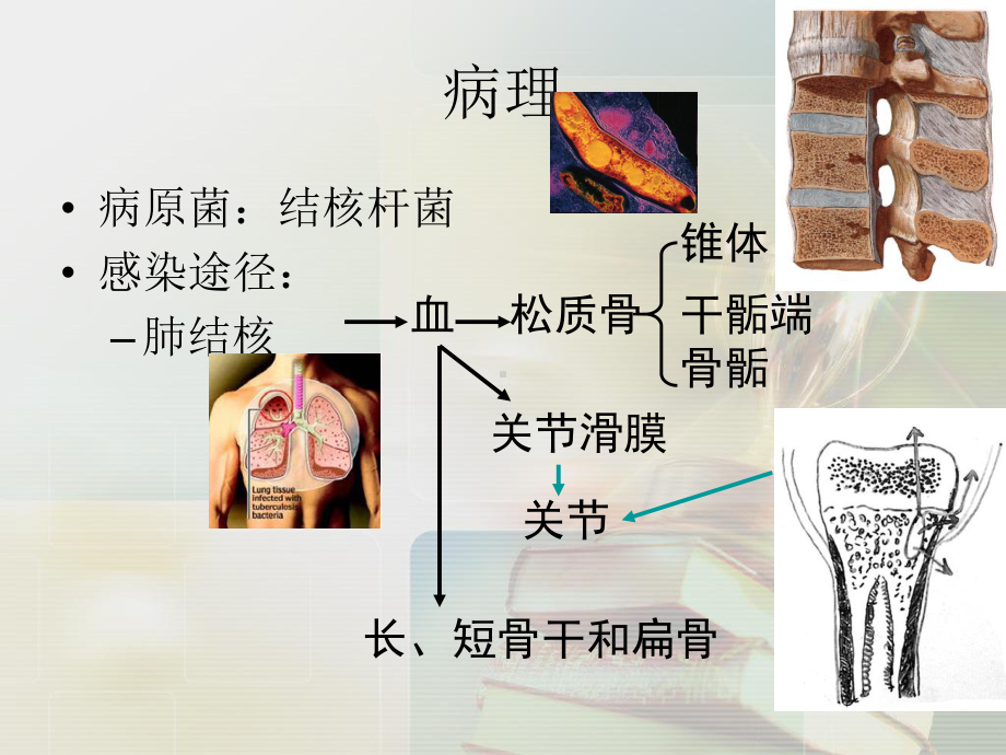 骨关节结核-课件.ppt_第2页