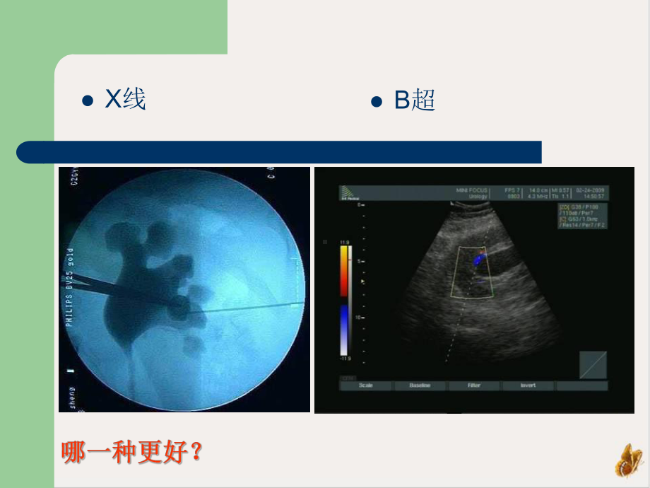 经皮肾穿刺点的选择课件.pptx_第2页