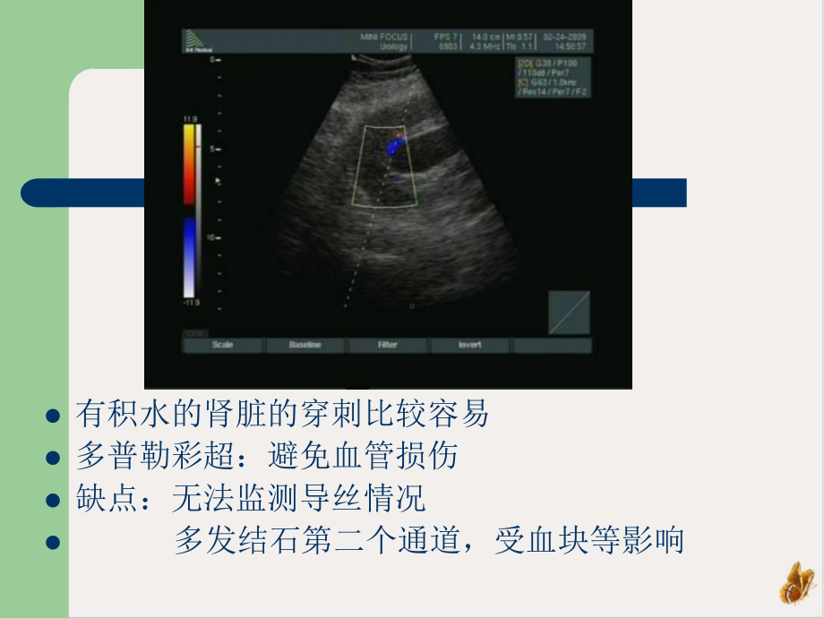 经皮肾穿刺点的选择课件.pptx_第3页