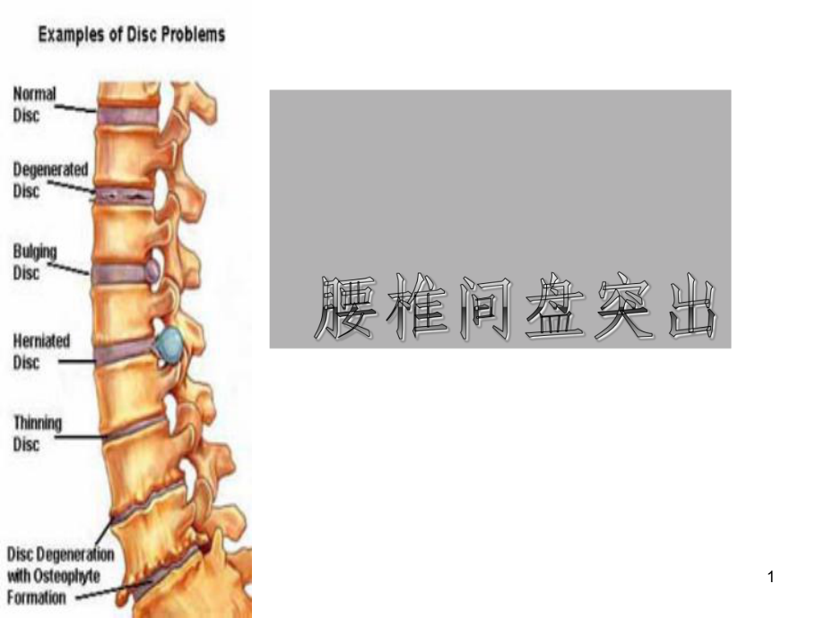 (腰椎间盘突出与腰肌劳损)运动康复教学课件.ppt_第1页