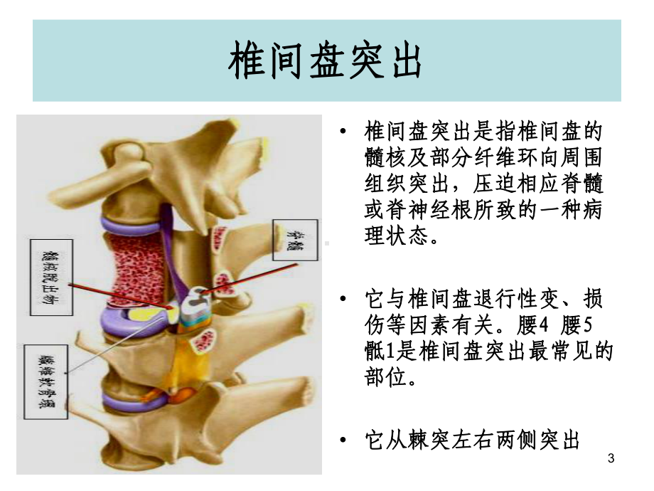 (腰椎间盘突出与腰肌劳损)运动康复教学课件.ppt_第3页