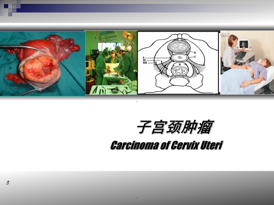 (医学)子宫颈肿瘤教学课件.ppt_第3页