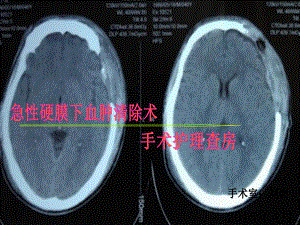 急性硬膜下血肿清除术刘岩课件.ppt