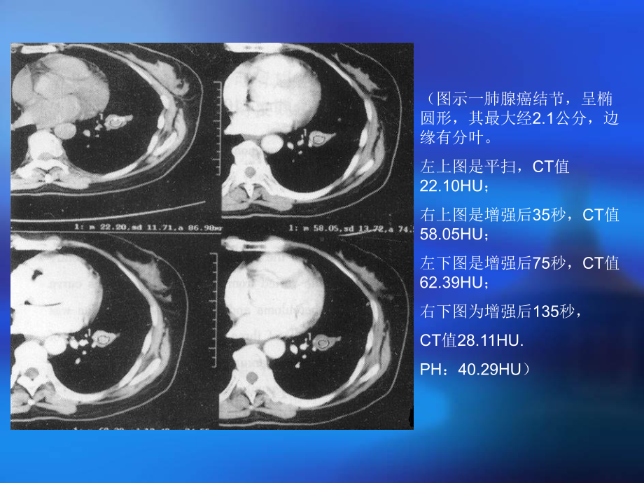 最新CT增强鉴别肺结节性质课件.ppt_第3页