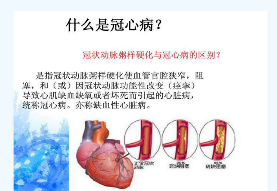 张晶PCI术护理查房课件.ppt_第2页