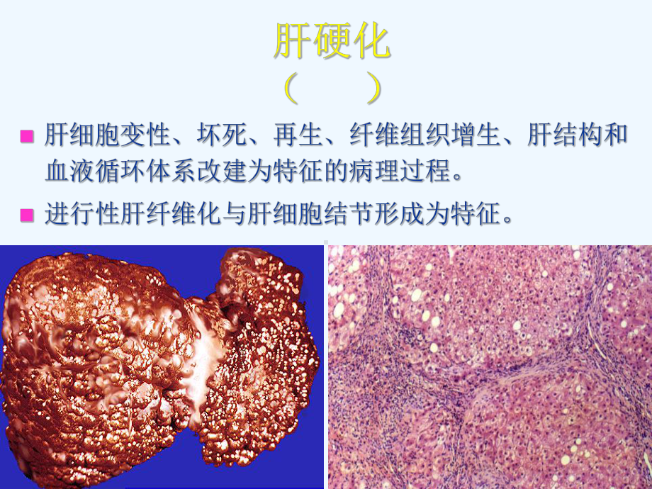 肝硬化结节分类及评价001课件.ppt_第3页