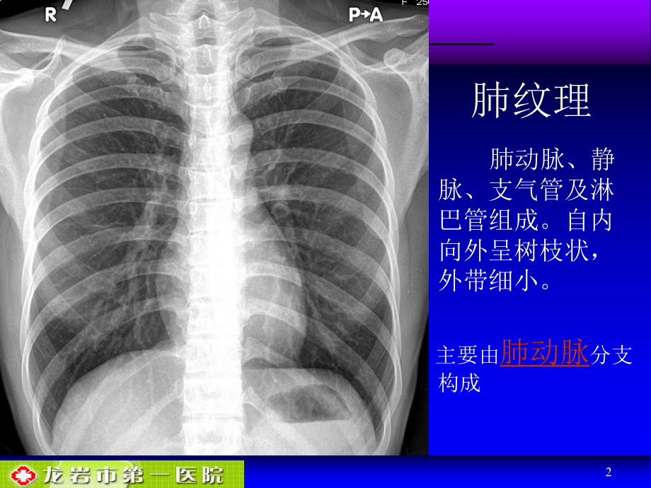 肺动脉栓塞影像诊断课件.ppt_第2页