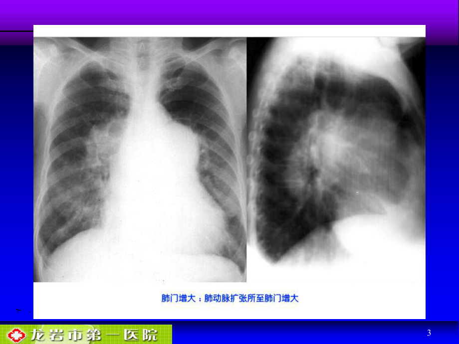 肺动脉栓塞影像诊断课件.ppt_第3页