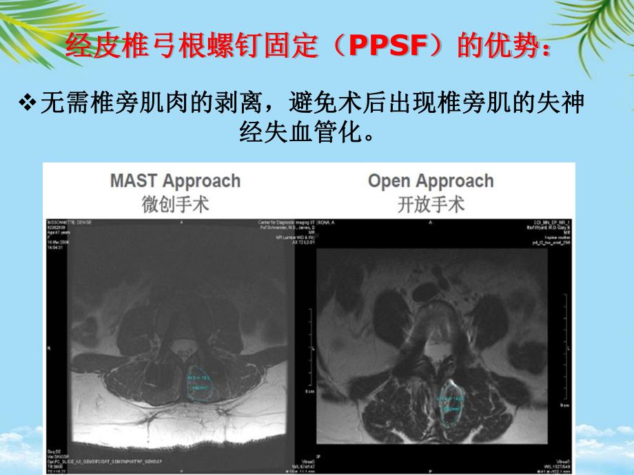 经皮椎弓根钉置入技术最全课件.ppt_第2页