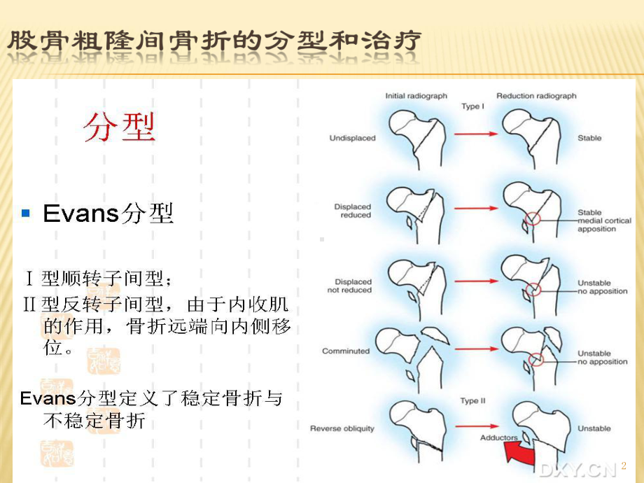 股骨粗隆间骨折分型和治疗优质课件.ppt_第2页