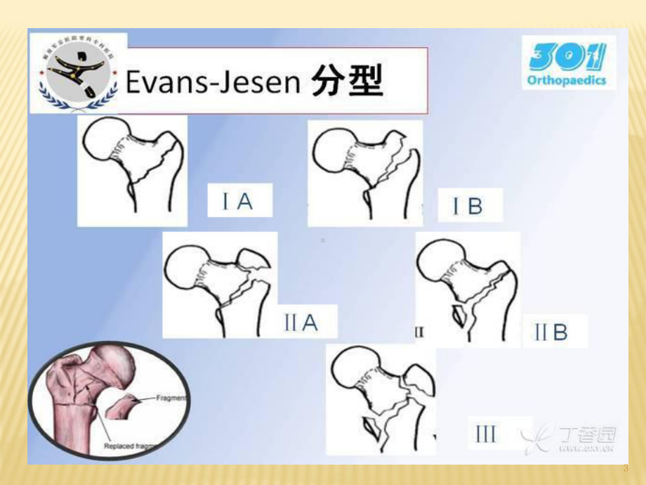 股骨粗隆间骨折分型和治疗优质课件.ppt_第3页