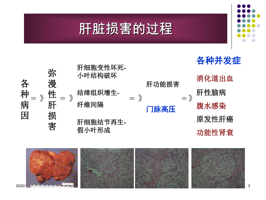 特利加压素对出血、腹水与肝肾综合征治疗课件.ppt_第3页