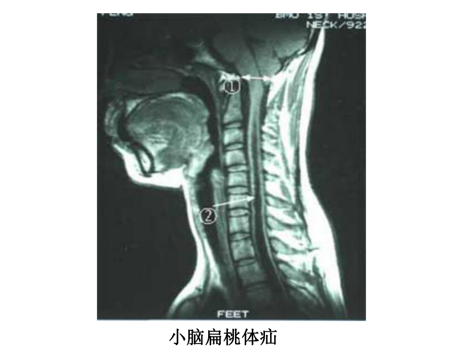 小脑和间脑护康总结课件.ppt_第3页