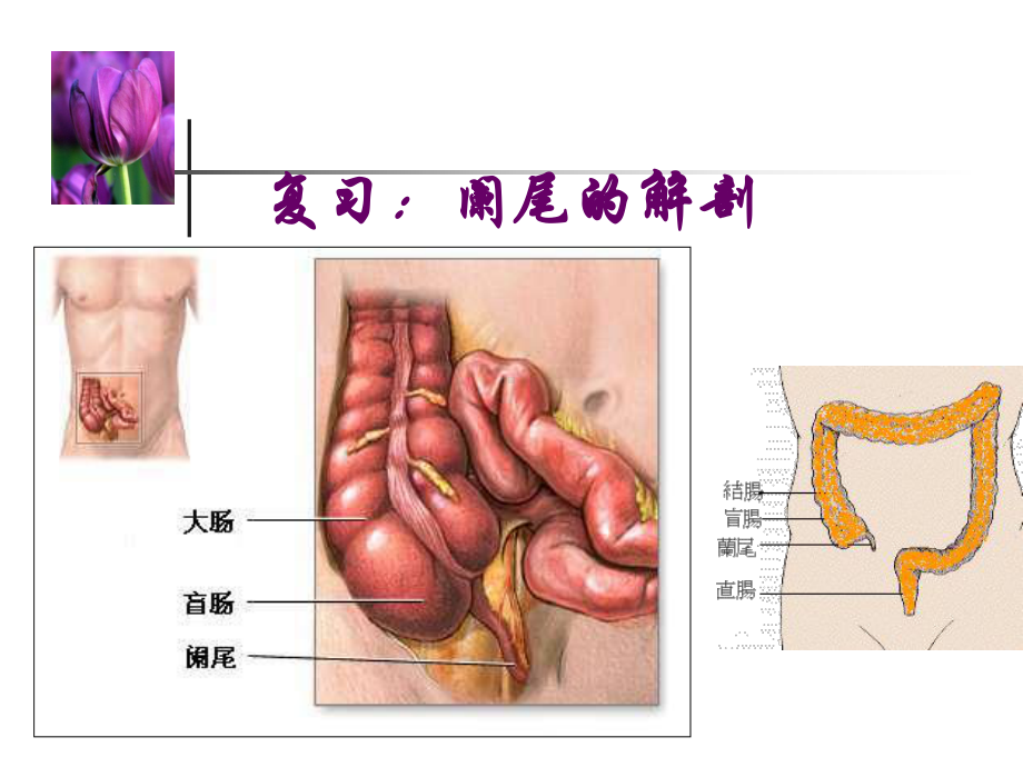 急性阑尾炎病人的护理-专课件.ppt_第3页