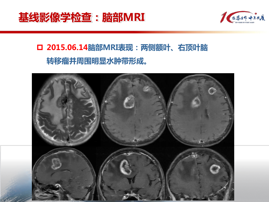 恩度治疗肺腺癌脑转移课件.pptx_第3页