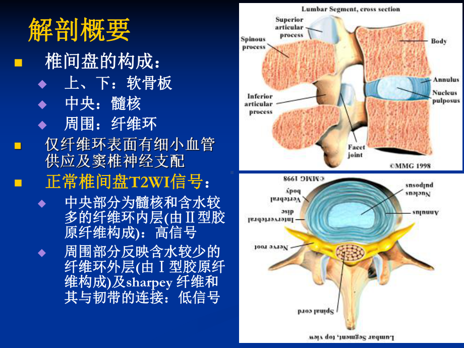 椎间盘突出影像诊断分析课件.pptx_第2页