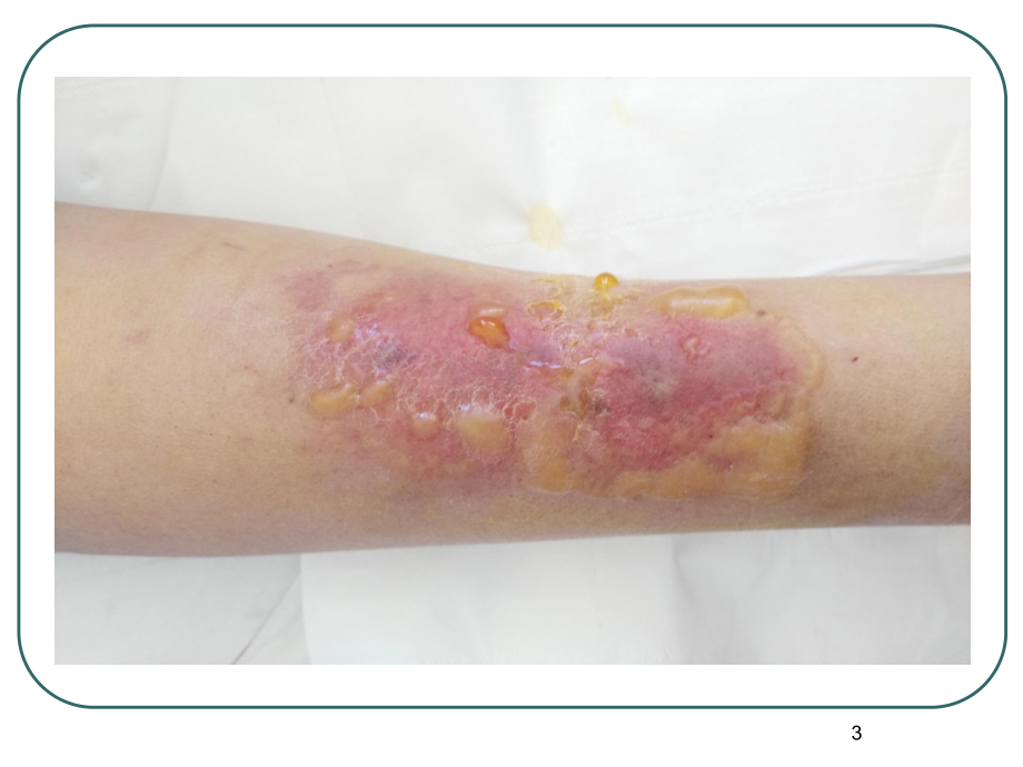 刺激性药物外渗后的处理教学课件.ppt_第3页