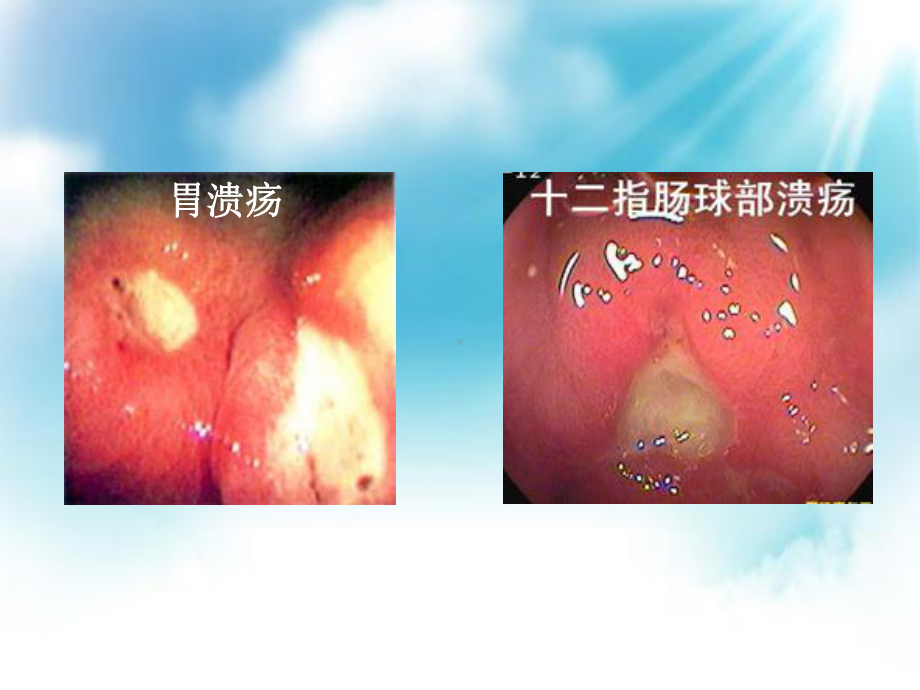 消化性溃疡饮食护理-SS课件.ppt_第3页