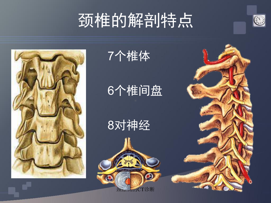 最新颈椎病的CT诊断课件.ppt_第3页